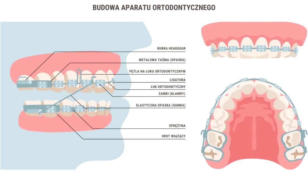 Co przed założeniem aparatu ortodontycznego: kluczowe informacje i kroki do podjęcia
