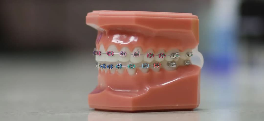 Jak przyciąć drut od aparatu ortodontycznego bez ryzyka uszkodzenia