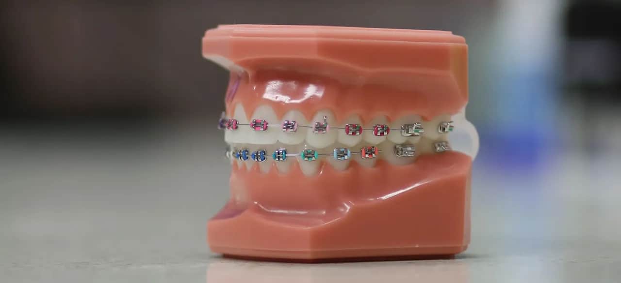 Jak przyciąć drut od aparatu ortodontycznego bez ryzyka uszkodzenia